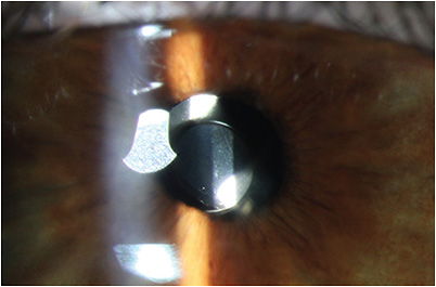 FIGURE 3: Note the slit lamp image of the pinhole implant in situ. IMAGE COURTESY MICHAEL E. SNYDER, MD