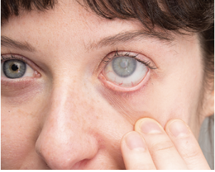 The presence of a corneal opacity, which can occur from an eye infection or trauma, can hinder time-sensitive PPV. IMAGE COURTESY STOCK.ADOBE.COM  / ALESSANDRO GRANDINI