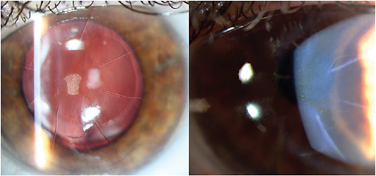 FIGURE 1: Retroillumination (left) and broad slit beam images (right) OD showed thick, irregular RK incisions, some of which were scarred, others of which appeared to be gaping slightly.IMAGES COURTESY MICHAEL E. SNYDER, MD