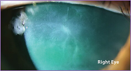 Corneal Physician | PentaVision