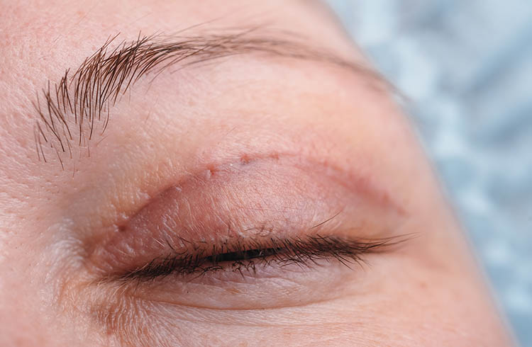 Upper eyelid blepharoplasty may influence biometric and keratometric measurements.