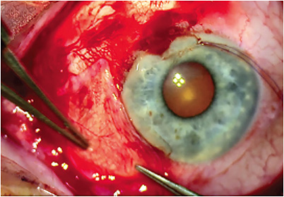 Figure 3: Intra-operative photograph showing placement of a cryopreserved amniotic membrane after excision is complete. IMAGE COURTESY OF JENNIFER A. TRAN, MD