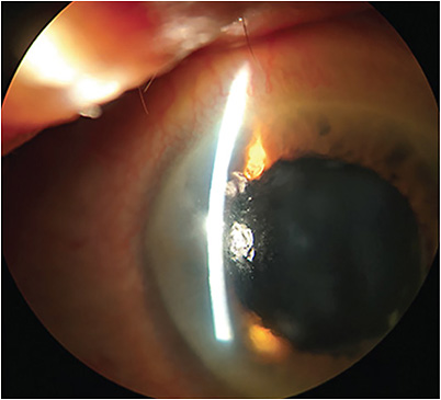 SND appears as elevated grey-white lesions typically located in the mid-peripheral or peripheral cornea. SND is treated with superficial keratectomy. Adjuvant PTK can be used as well to further smooth out the cornea after the nodule is excised. IMAGE COURTESY CHRIS RAPUANO, MD