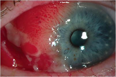 Figure 1: Note the slit lamp photograph of a large papillomatous OSSN present on the bulbar conjunctiva of a patient’s right eye. IMAGE COURTESY OF JENNIFER A. TRAN, MD